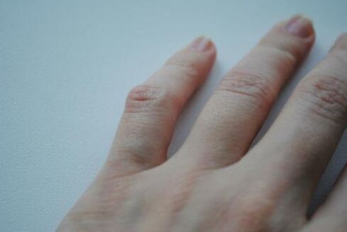 Apareció un bulto artrítico en el dedo meñique. 