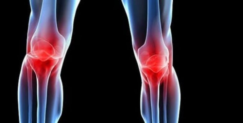 osteoartritis de la rodilla