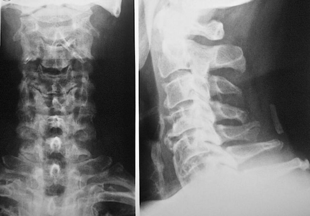 radiografía de la columna cervical con osteocondrosis