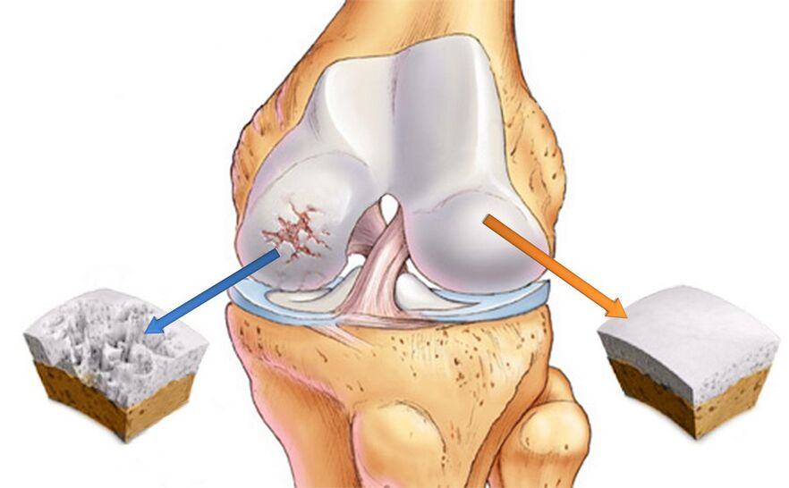 Artrosis de la articulación de la rodilla