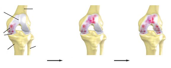El grado de artrosis de la articulación de la rodilla