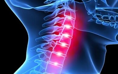 Síntomas de la osteocondrosis de la columna cervical