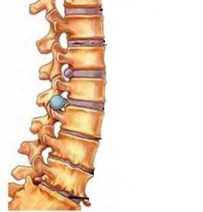 cómo se desarrolla la osteocondrosis de la región cervical