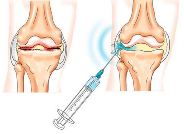 inyecciones intraarticulares para la artrosis de rodilla