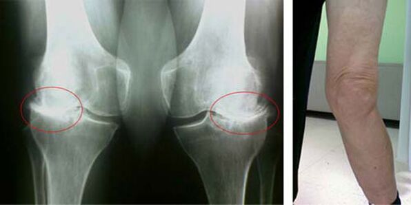 radiografía de artrosis de rodilla
