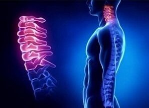 Las razones para el desarrollo de la osteocondrosis cervical