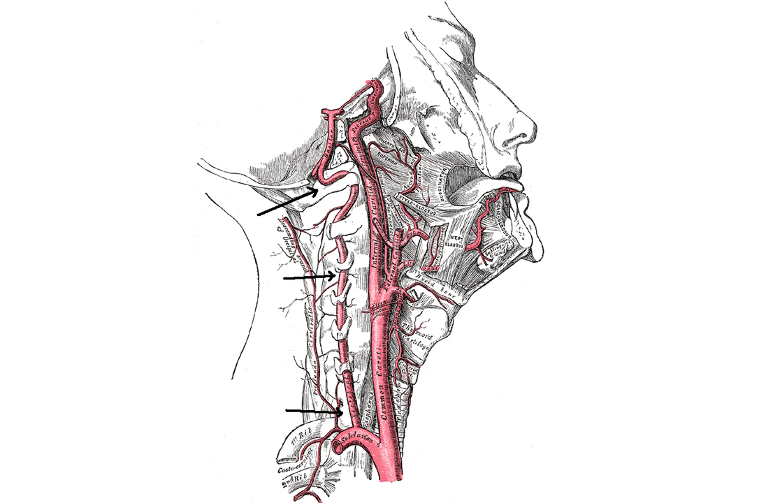 compresión de la arteria vertebral con osteocondrosis cervical