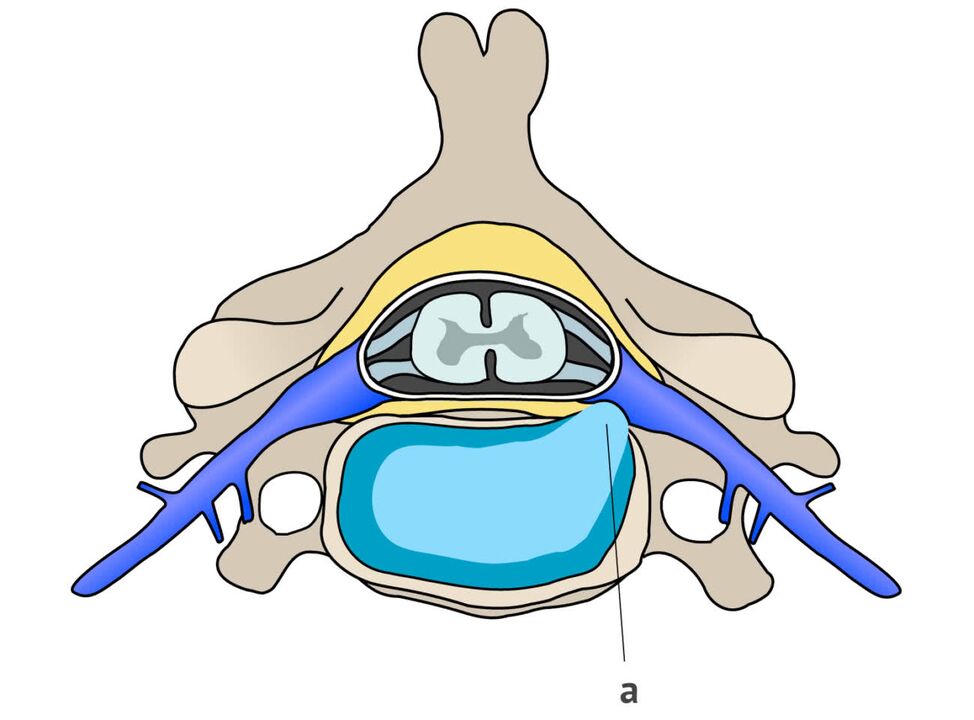 hernia intervertebral con osteocondrosis cervical