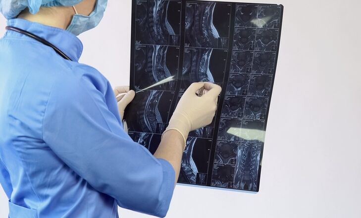 El diagnóstico de osteocondrosis cervical se realiza sobre la base de un estudio de resonancia magnética. 