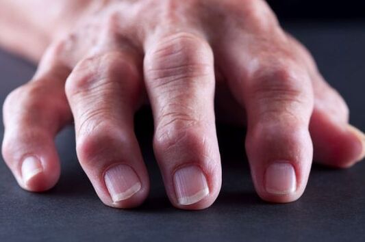 Deformidades articulares de los dedos debido a artrosis o artritis. 